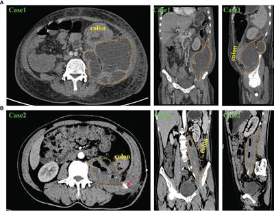 Retroperitoneal abscess as a presentation of colon cancer: The largest case set analysis to date, which extracted from our unit and the literature